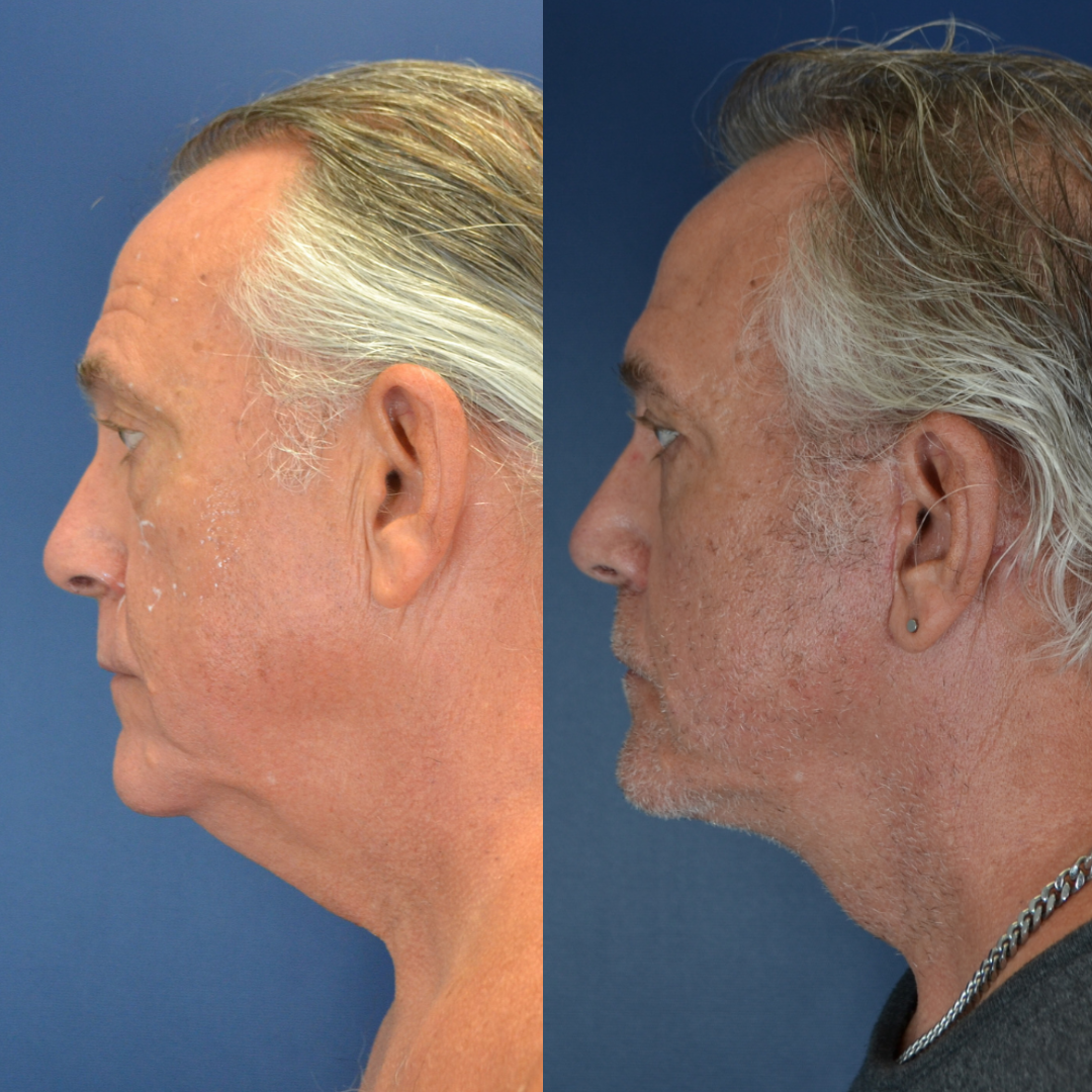 Facelift Before & after