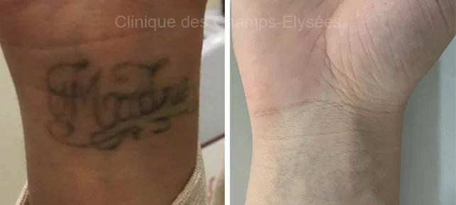 Avant/Après traitement capillaire