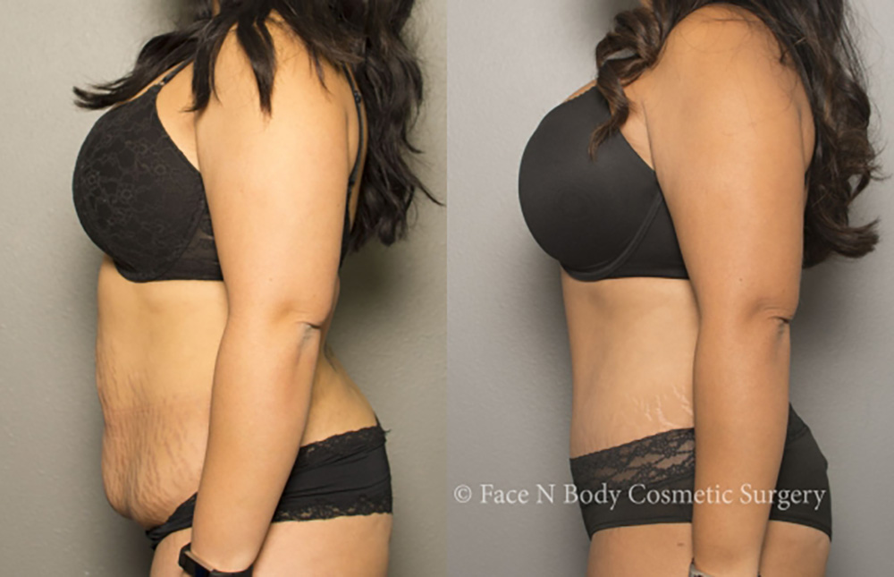 tummy tuck before and after