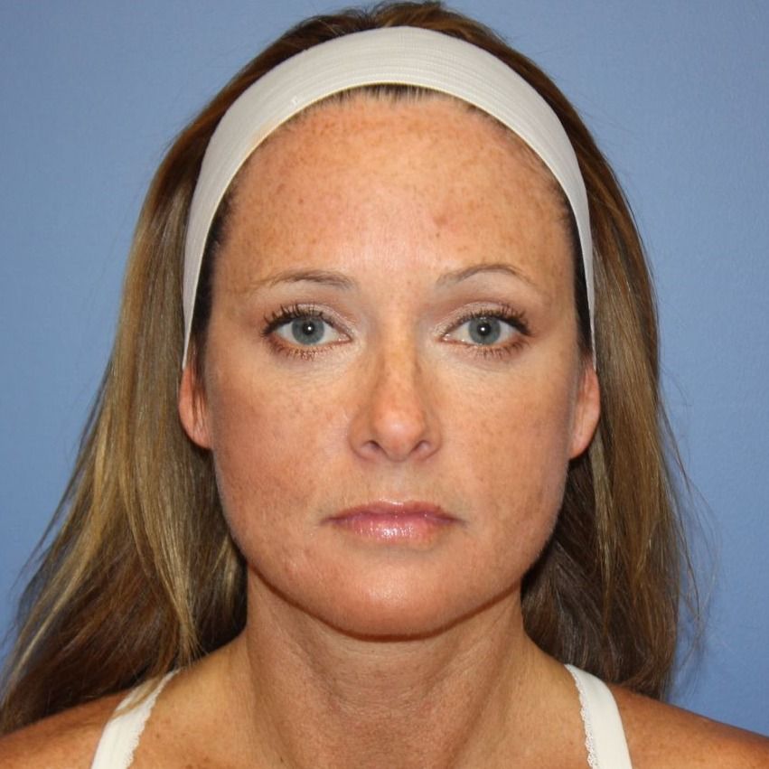 Facial Rejuvenation Model Facial Rejuvenation Model