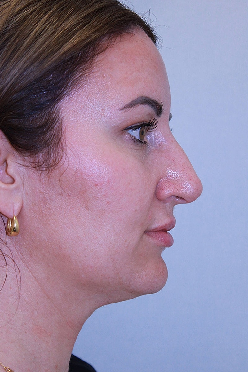 rhinoplasty before and after