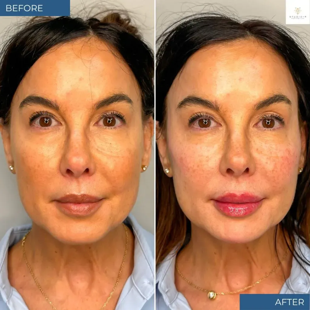 fillers results