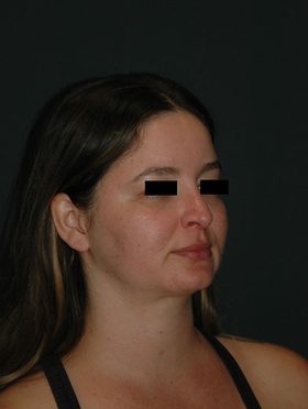 rhinoplasty patient 2 - after